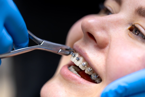 Referred To A Braces Specialist? Here&#    ;s What To Know