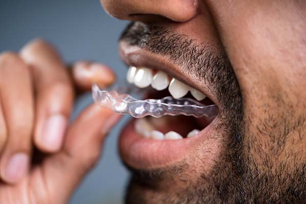 Am I A Candidate For Clear Aligners?