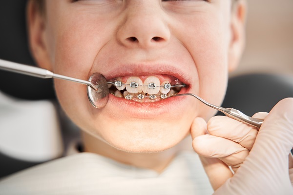 How Kids&#    ; Braces Have Improved