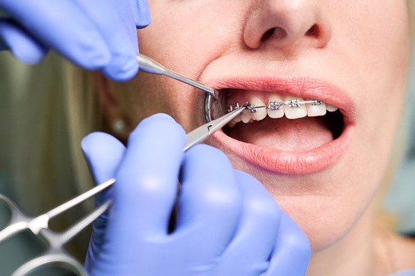 Leading Advantages Of Metal Braces