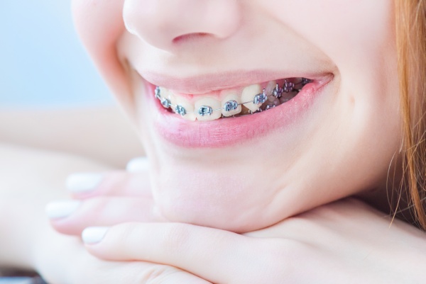 What To Expect At First Orthodontic Evaluation